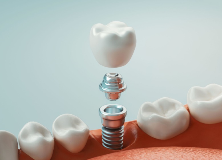 Implantes dentales