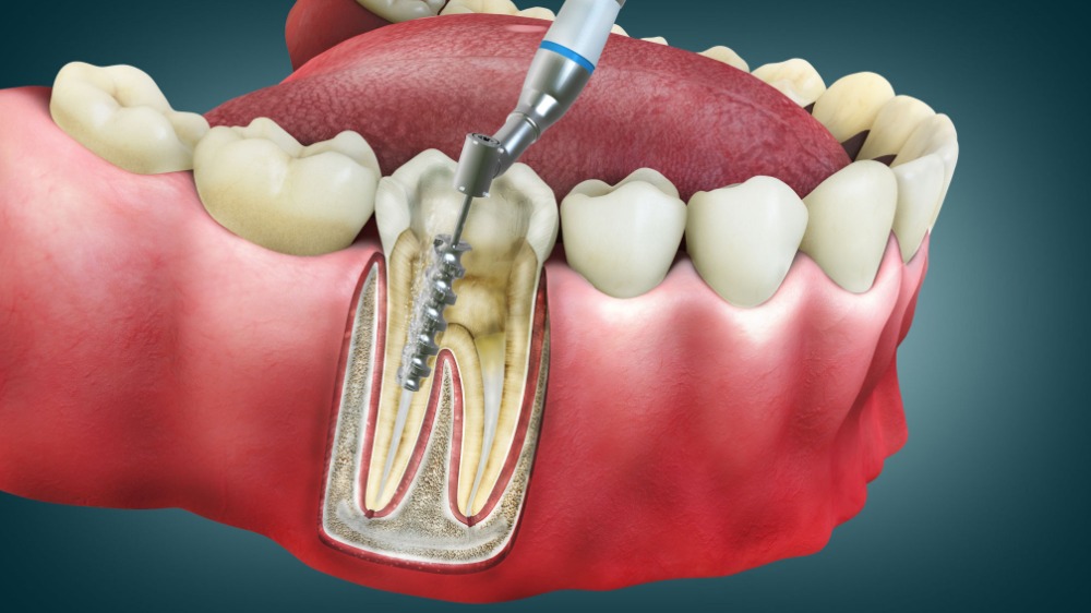 ENDODONCIA